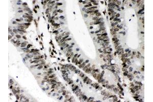 CIITA was detected in paraffin-embedded sections of human intestinal cancer tissues using rabbit anti- CIITA Antigen Affinity purified polyclonal antibody (Catalog # ) at 1 ?