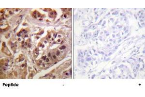 Immunohistochemistry analysis of paraffin-embedded human breast carcinoma tissue using GRLF1 polyclonal antibody . (GRLF1 anticorps)