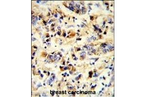 Formalin-fixed and paraffin-embedded human breast carcinoma reacted with EGFR Antibody, which was peroxidase-conjugated to the secondary antibody, followed by DAB staining. (EGFR anticorps)