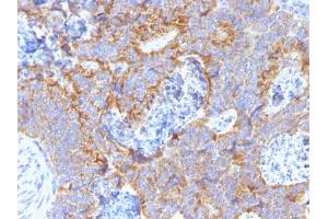 Formalin-fixed, paraffin-embedded human Colon stained with CEA Mouse Monoclonal Antibody (C66/1291).