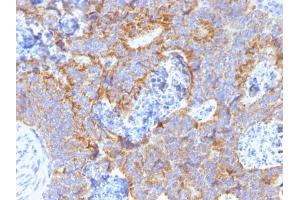 Formalin-fixed, paraffin-embedded human Colon stained with CEA Mouse Monoclonal Antibody (C66/1291). (CEACAM5 anticorps)