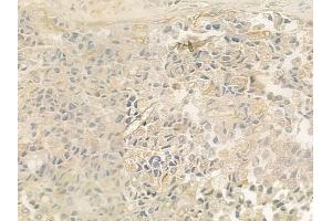 ABIN6259274 and ABIN6275418 at 1/100 staining human prostate carcinoma by IHC-P.