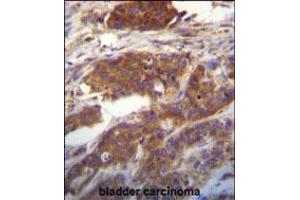 Ufc1 Antibody immunohistochemistry analysis in formalin fixed and paraffin embedded human bladder carcinoma followed by peroxidase conjugation of the secondary antibody and DAB staining.