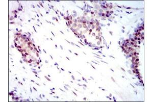 Immunohistochemical analysis of paraffin-embedded prostate cancer tissues using YAP1 mouse mAb with DAB staining.