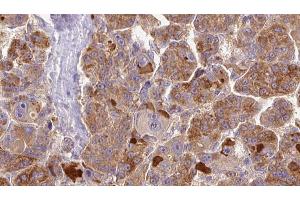 ABIN6273855 at 1/100 staining Human liver cancer tissue by IHC-P. (GPR146 anticorps  (Internal Region))