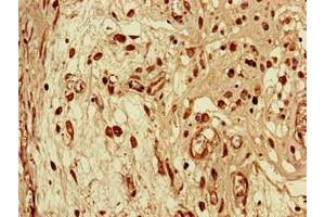 Immunohistochemistry of paraffin-embedded human lung cancer using ABIN7168651 at dilution of 1:100 (SEC14L3 anticorps  (AA 201-400))
