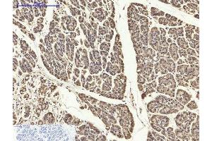 Immunohistochemistry of paraffin-embedded Human stomach cancer tissue using PYCARD Polyclonal Antibody at dilution of 1:200.