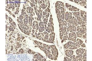 Immunohistochemistry of paraffin-embedded Human stomach cancer tissue using PYCARD Polyclonal Antibody at dilution of 1:200. (PYCARD anticorps)