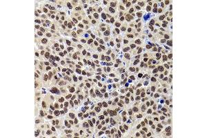 Immunohistochemistry of paraffin-embedded human kidney cancer using PHIP antibody at dilution of 1:100 (40x lens). (PHIP anticorps)