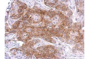 IHC-P Image SIPA1 antibody [C3], C-term detects SIPA1 protein at weak membrane and cytosol on Cal27 xenograft by immunohistochemical analysis.