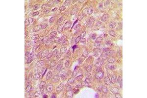 Immunohistochemical analysis of IGFBP3 staining in human breast cancer formalin fixed paraffin embedded tissue section. (IGFBP3 anticorps)