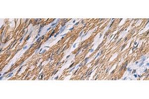 Immunohistochemistry of paraffin-embedded Human gastric cancer tissue using KCNH7 Polyclonal Antibody at dilution of 1:30(x200)