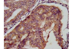 IHC image of ABIN7151045 diluted at 1:500 and staining in paraffin-embedded human endometrial cancer performed on a Leica BondTM system.