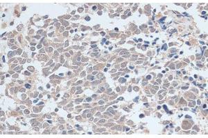 Immunohistochemistry of paraffin-embedded Human lung cancer using ZNF581 Polyclonal Antibody at dilution of 1:100 (40x lens). (ZNF581 anticorps)