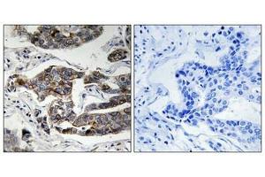 Immunohistochemical analysis of paraffin-embedded human breast carcinoma tissue using Girdin (Phospho-Ser1417) antibody (left)or the same antibody preincubated with blocking peptide (right). (Girdin anticorps  (pSer417))