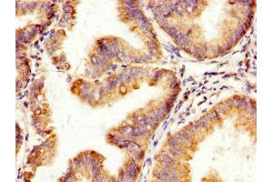 IHC image of ABIN7170472 diluted at 1:200 and staining in paraffin-embedded human endometrial cancer performed on a Leica BondTM system. (SPA17 anticorps  (AA 1-146))