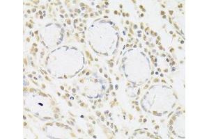 Immunohistochemistry of paraffin-embedded Human gastric cancer using SNRPA Polyclonal Antibody at dilution of 1:100 (40x lens).