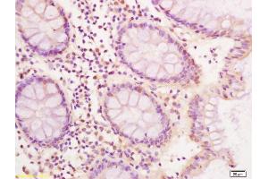 Formalin-fixed and paraffin embedded human colon carcinoma labeled with Anti CDX2 Polyclonal Antibody, Unconjugated (ABIN732173) at 1:200 followed by conjugation to the secondary antibody and DAB staining