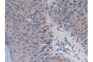 Detection of PCSK5 in Human Skin cancer Tissue using Polyclonal Antibody to Proprotein Convertase Subtilisin/Kexin Type 5 (PCSK5)