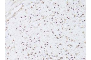 Immunohistochemistry of paraffin-embedded human leiomyoma of uterus using FKBP4 Antibody (ABIN5973289) at dilution of 1/100 (40x lens). (FKBP4 anticorps)