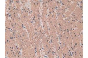 IHC-P analysis of Human Stomach Cancer Tissue, with DAB staining.