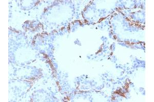 Formalin-fixed, paraffin-embedded human Prostate Carcinoma stained with Cytokeratin 6A (KRT6A) Mouse Monoclonal Antibody (KRT6A/2368).