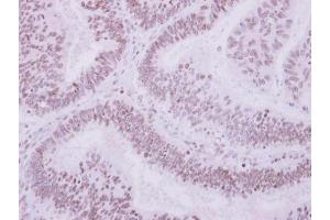 IHC-P Image Immunohistochemical analysis of paraffin-embedded human colon carcinoma, using ULK4, antibody at 1:500 dilution.