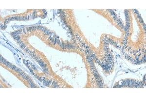 Immunohistochemistry of paraffin-embedded Human colon cancer using ASGR1 Polyclonal Antibody at dilution of 1:50 (Asialoglycoprotein Receptor 1 anticorps)