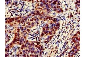 Immunohistochemistry of paraffin-embedded human bladder cancer using ABIN7151606 at dilution of 1:100 (Emerin anticorps  (AA 1-222))