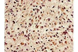 Immunohistochemistry of paraffin-embedded human glioma using ABIN7151635 at dilution of 1:100 (Nth Endonuclease III-Like 1 (NTHL1) (AA 31-312) anticorps)