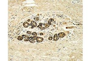 IHC analysis of FFPE human breast carcinoma with HER3 antibody