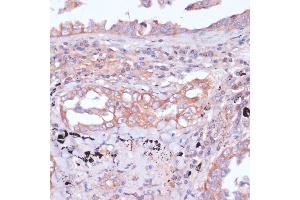 Immunohistochemistry of paraffin-embedded human lung cancer using RPL32 antibody (ABIN6129104, ABIN6147138, ABIN6147139 and ABIN6216824) at dilution of 1:100 (40x lens). (RPL32 anticorps  (AA 1-135))