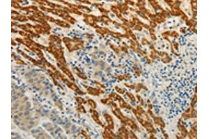 The image on the left is immunohistochemistry of paraffin-embedded Human liver cancer tissue using ABIN7190314(CMTM7 Antibody) at dilution 1/30, on the right is treated with synthetic peptide. (CMTM7 anticorps)