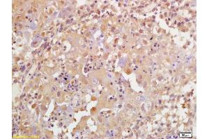 Formalin-fixed and paraffin embedded human breast carcinoma labeled with Rabbit Anti Phospho-BRCA1(Ser1189) Polyclonal Antibody, Unconjugated (ABIN756637) at 1:200 followed by conjugation to the secondary antibody and DAB staining (BRCA1 anticorps  (pSer1189))