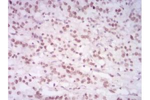 Immunohistochemical analysis of paraffin-embedded stomach cancer tissues using HIST2H4A(20Me) mouse mAb with DAB staining.