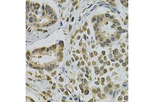 Immunohistochemistry of paraffin-embedded human breast cancer using EBAG9 Antibody. (RCAS1 anticorps  (AA 28-213))