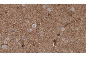 ABIN6277796 at 1/100 staining Human brain cancer tissue by IHC-P. (CLCN3 anticorps  (N-Term))