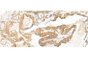 Immunohistochemistry of paraffin-embedded Human thyroid cancer tissue using HEBP1 Polyclonal Antibody at dilution of 1:60(x200) (HEBP1 anticorps)