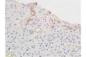 Formalin-fixed and paraffin embedded human brain glioblastoma labeled with Anti-Vitamin D Receptor/VDR Polyclonal Antibody, Unconjugated (ABIN682513) at 1:200 followed by conjugation to the secondary antibody and DAB staining