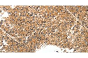 Immunohistochemistry of paraffin-embedded Human liver cancer tissue using TEK Polyclonal Antibody at dilution 1:50 (TEK anticorps)