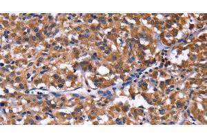 Immunohistochemistry of paraffin-embedded Human thyroid cancer tissue using SELPLG Polyclonal Antibody at dilution 1:50 (SELPLG anticorps)