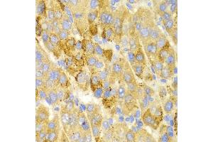 Immunohistochemistry of paraffin-embedded human liver cancer using LAMP3 antibody (ABIN5971497) at dilution of 1/100 (40x lens). (LAMP3 anticorps)