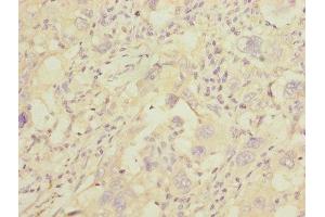 Immunohistochemistry of paraffin-embedded human liver cancer using ABIN7154068 at dilution of 1:100
