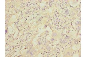 Immunohistochemistry of paraffin-embedded human liver cancer using ABIN7154068 at dilution of 1:100 (GGTLC2 anticorps  (AA 1-218))