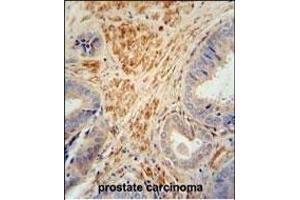 FSTL1 antibody (C-term) (ABIN654491 and ABIN2844224) immunohistochemistry analysis in formalin fixed and paraffin embedded human prostate carcinoma followed by peroxidase conjugation of the secondary antibody and DAB staining.