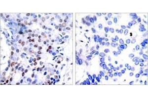 Immunohistochemistry analysis of paraffin-embedded human breast carcinoma tissue, using c-Jun (Ab-91) Antibody. (C-JUN anticorps  (AA 58-107))