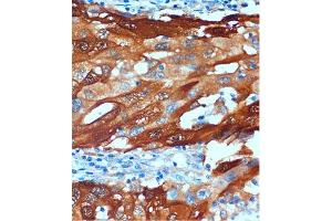 Immunohistochemistry of paraffin-embedded Human breast cancer using Secretagogin (Secretagogin (SCGN)) Rabbit pAb (ABIN6130685, ABIN6147431, ABIN6147432 and ABIN6216698) at dilution of 1:100 (40x lens). (SCGN anticorps  (AA 1-276))