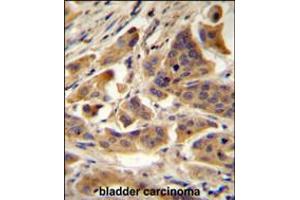 RBCK1 (UBCE7IP3) Antibody immunohistochemistry analysis in formalin fixed and paraffin embedded human bladder carcinoma followed by peroxidase conjugation of the secondary antibody and DAB staining. (RBCK1 anticorps  (N-Term))