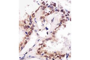 Paraformaldehyde-fixed, paraffin embedded human lung adenocarcinoma, Antigen retrieval by boiling in sodium citrate buffer (pH6.