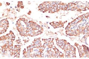 Immunohistochemistry of paraffin-embedded Human thyroid cancer using FRMD6 Polyclonal Antibody at dilution of 1:100 (40x lens). (FRMD6 anticorps)